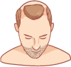 Haartransplantation Karlsruhe - Bild von Mann mit mittlerem Haarausfall