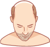 Haartransplantation Karlsruhe - Bild von Mann mit starkem Haarausfall