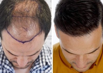 Haartransplantation Karlsruhe - Vergleichsbild vor und nach einer Haartransplantation