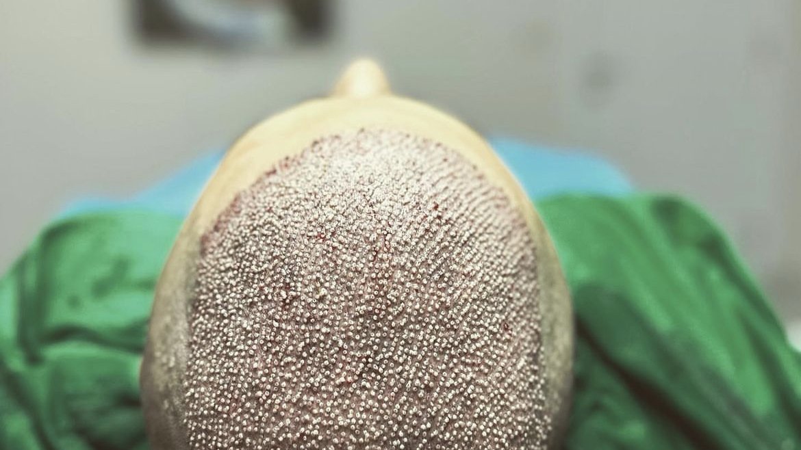 Haartransplantation Karlsruhe - Vergleichsbild vor einer Haartransplantation